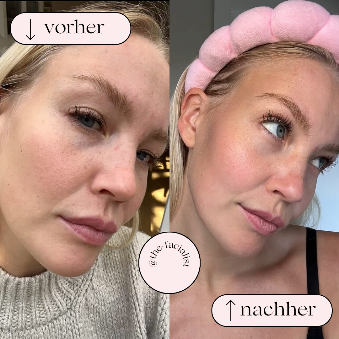 Facial Pore Cleaner with Hydrogen Oxygen Water Jet Technology for Deep Cleansing, Blackhead Removal & Skincare at Home | Thomler