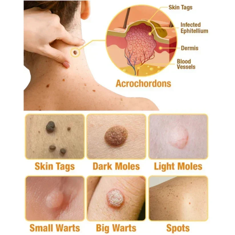 Spray para eliminar verrugas y etiquetas cutáneas con extracto natural de veneno de abeja para un cutis sin imperfecciones con tratamiento en casa