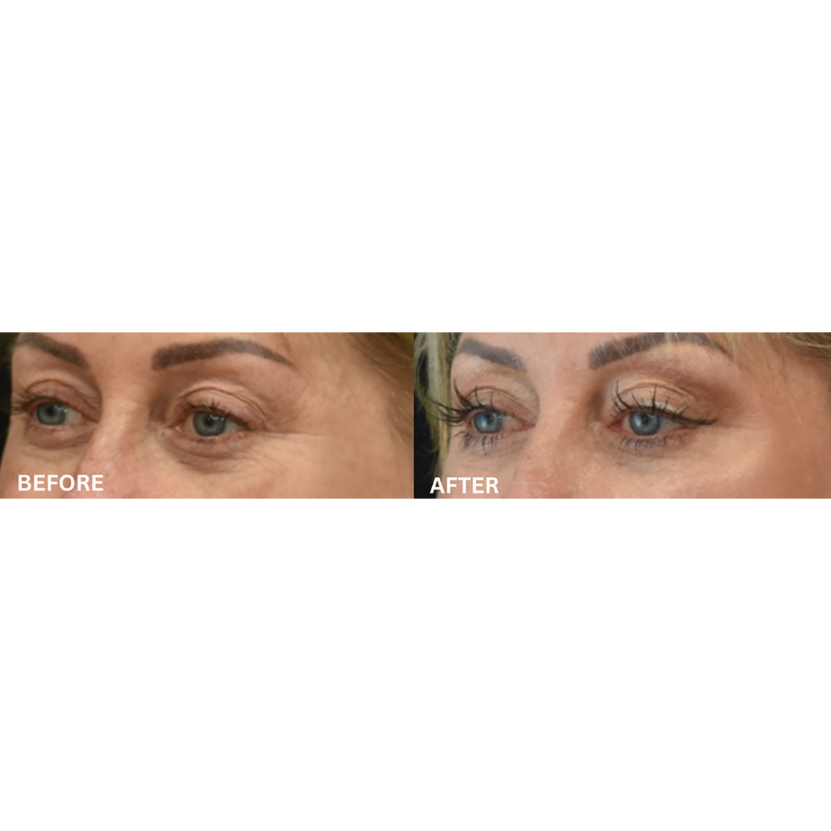 Máscara ocular de silicona con terapia de calor y EMS