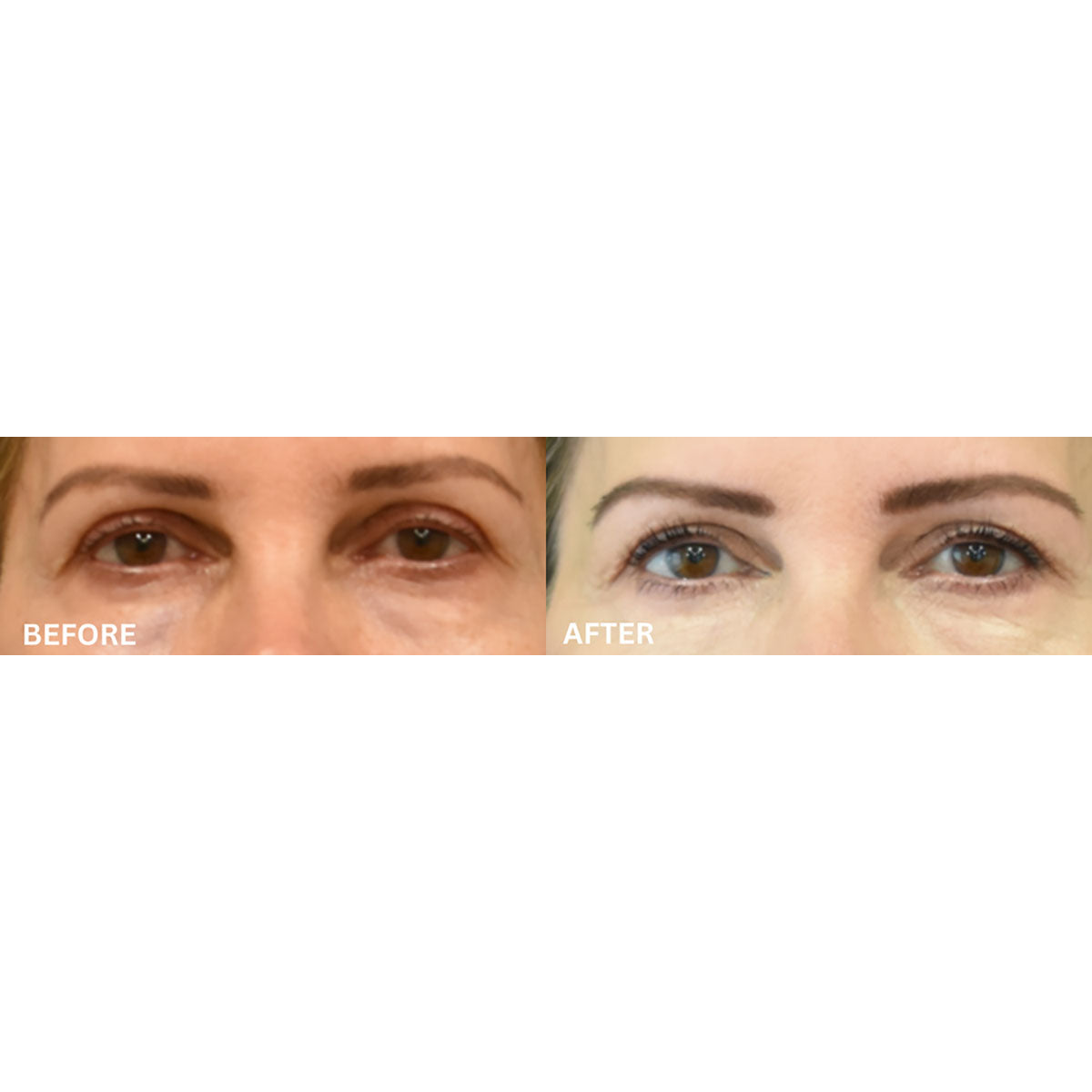 Máscara ocular de silicona con terapia de calor y EMS
