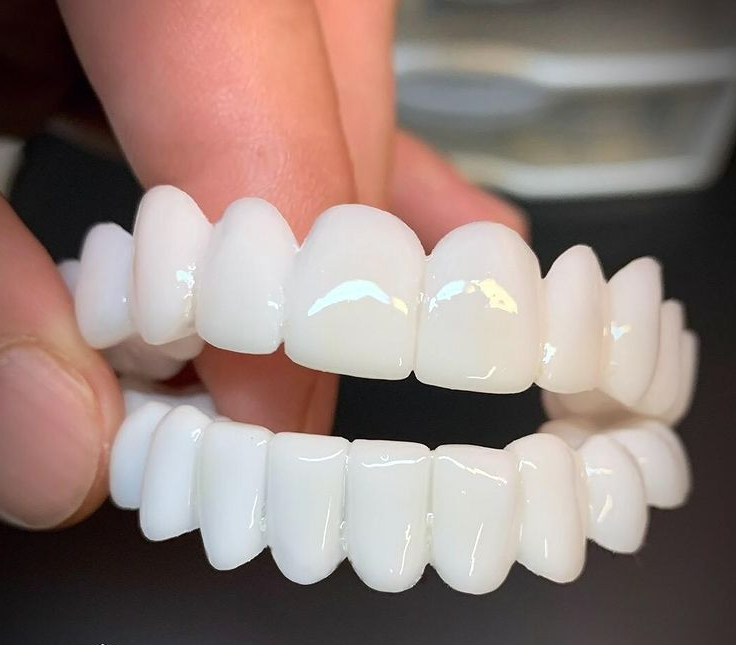 Aufsteckbare kosmetische Veneers zur Abdeckung von Zahnlücken, Verfärbungen und fehlenden Zähnen – wiederverwendbare Lächeln-Optimierung für tägliches Selbstvertrauen und besondere Anlässe
