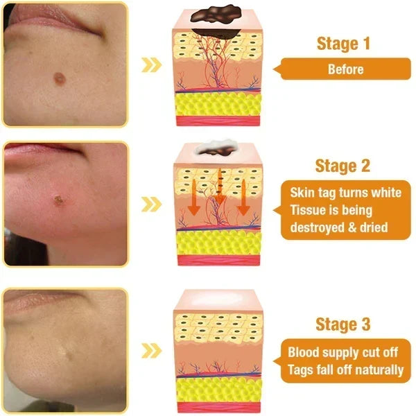 Spray para eliminar verrugas y etiquetas cutáneas con extracto natural de veneno de abeja para un cutis sin imperfecciones con tratamiento en casa