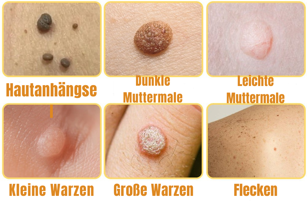 Skin Tag Removal Spray for Warts & Blemishes - Bee Venom Formula - Pain-Free Application - For All Skin Types - Face, Neck, Body Treatment