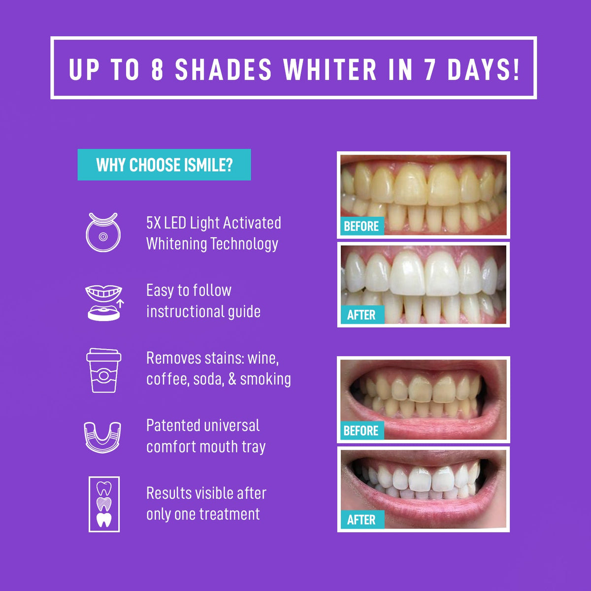 iSmile Teeth Whitening Kit