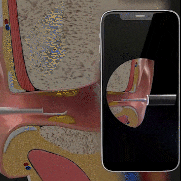 Draadloze oorreinigingscamera met HD-lens en siliconen opzetstuk voor iPhone & Android, veilig hulpmiddel voor het verwijderen van oorsmeer