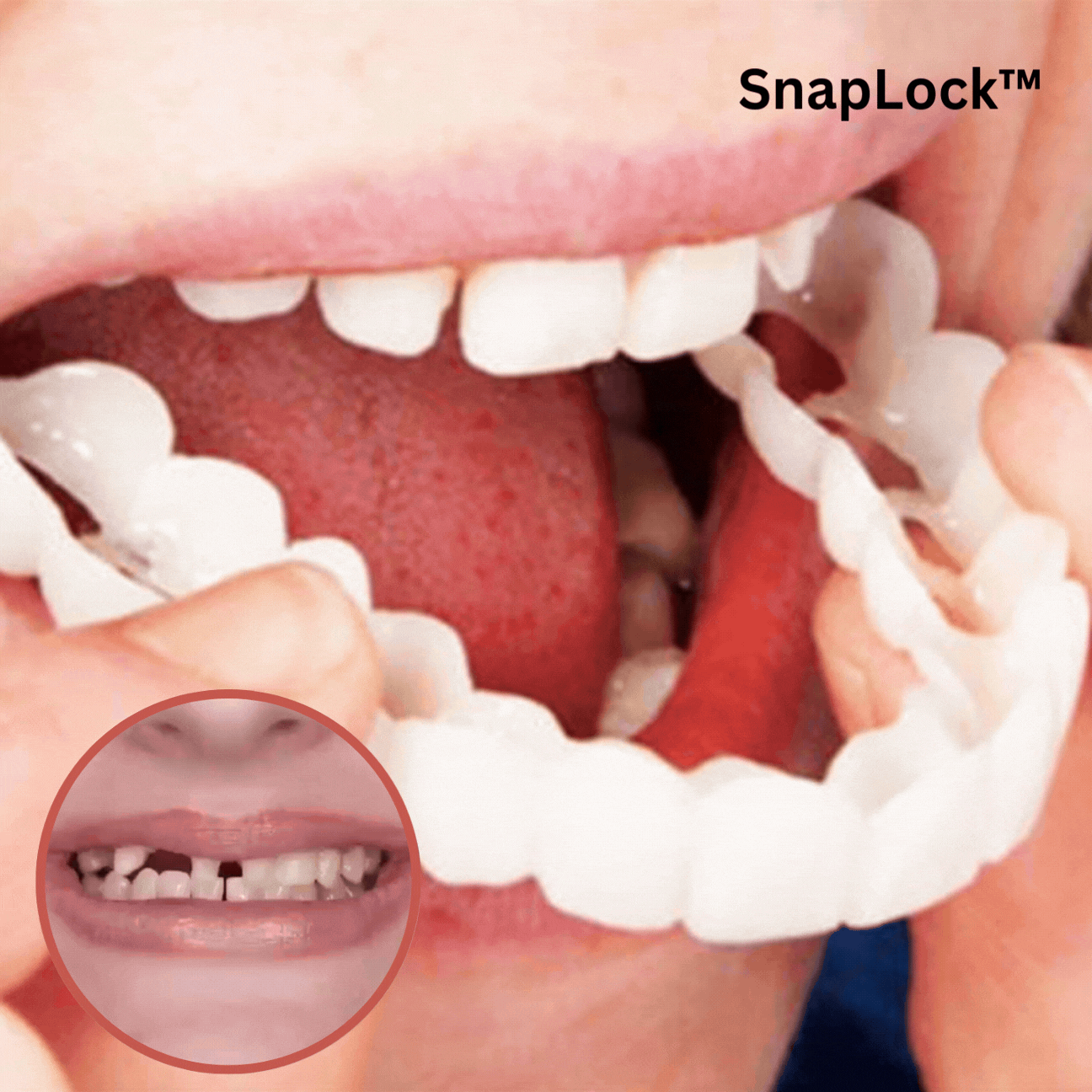 Snap-On Dental Veneers – Temporary Cosmetic Teeth Covers for Upper & Lower Jaw